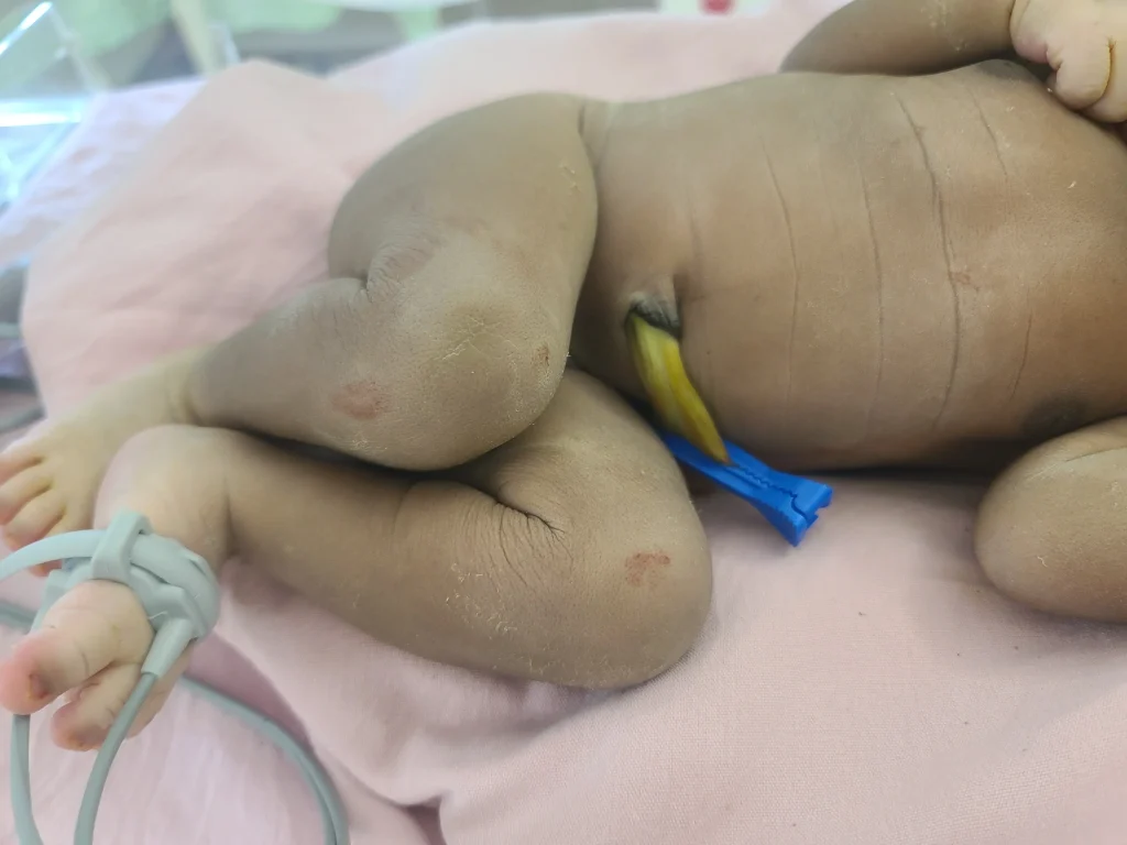 Meconium Aspiration Syndrome (MAS): Causes, Symptoms, Treatment nursing intervention & Prevention